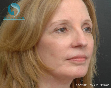 <?php echo $pk; ?> - After Case 12