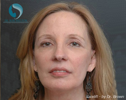 <?php echo $pk; ?> - After Case 13