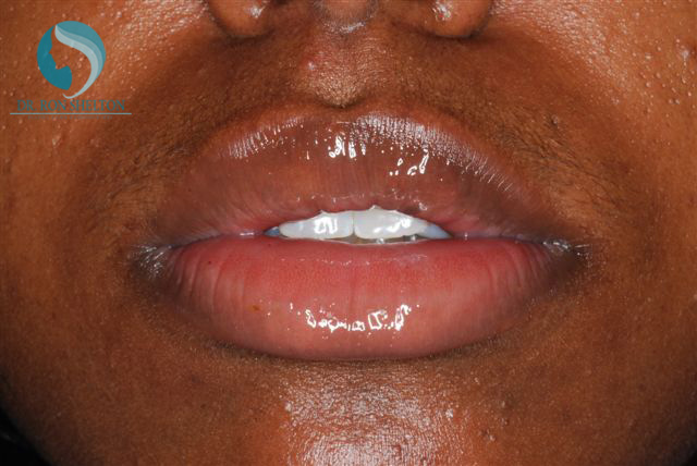 <?php echo $pk; ?> - After Case 5