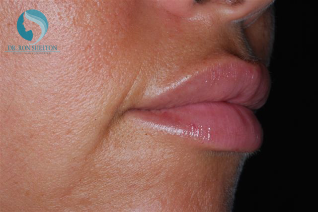 <?php echo $pk; ?> - After Case 4