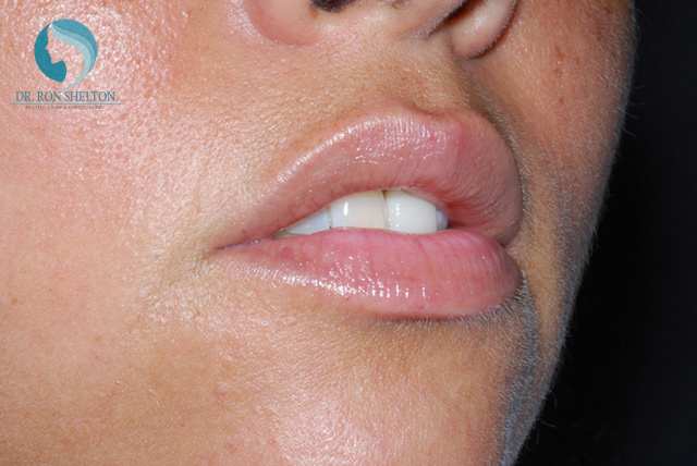 <?php echo $pk; ?> - Before Case 4