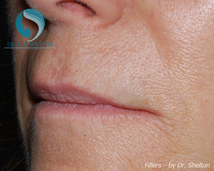 <?php echo $pk; ?> - After Case 1