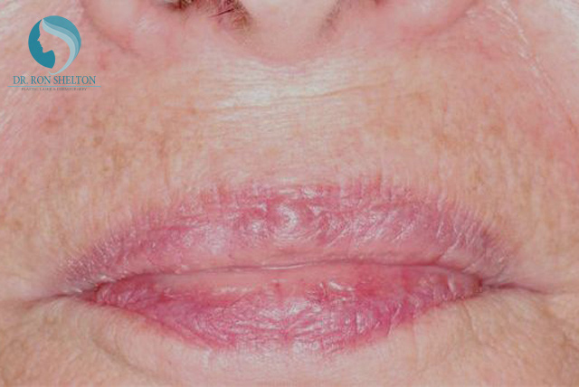 <?php echo $pk; ?> - After Case 5