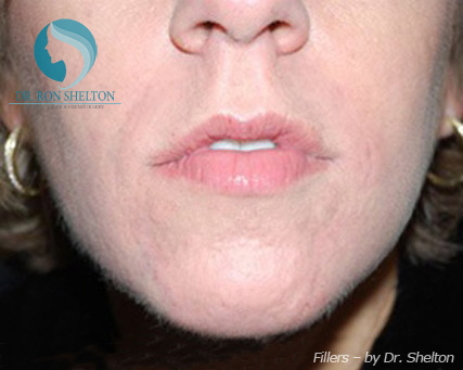 <?php echo $pk; ?> - After Case 2