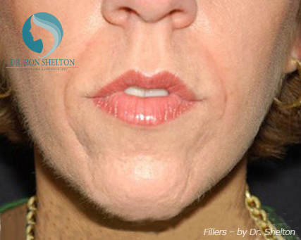 <?php echo $pk; ?> - Before Case 2