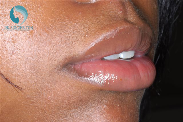 <?php echo $pk; ?> - After Case 5