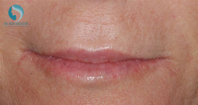 <?php echo $pk; ?> - After Case 3