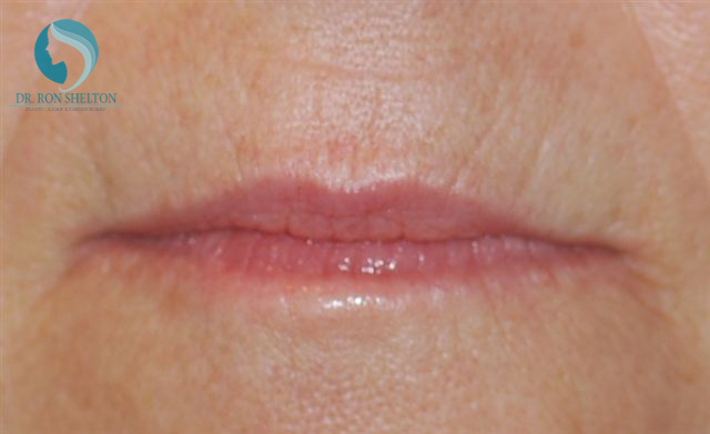 <?php echo $pk; ?> - Before Case 3