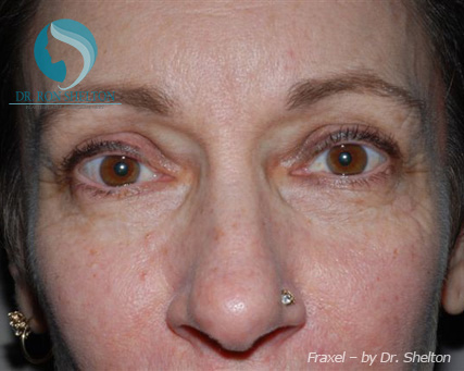 <?php echo $pk; ?> - Before Case 2