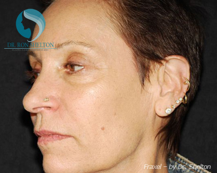 <?php echo $pk; ?> - Before Case 3