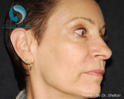 <?php echo $pk; ?> - Before Case 4