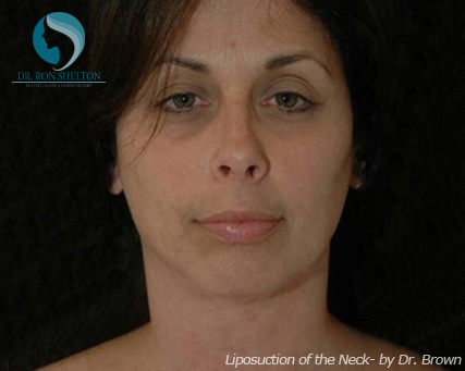 <?php echo $pk; ?> - After Case 7