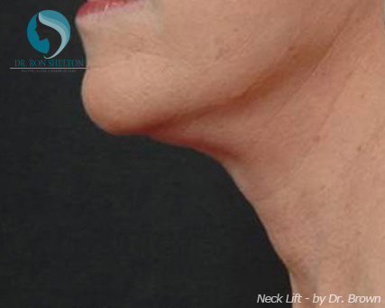 <?php echo $pk; ?> - After Case 2