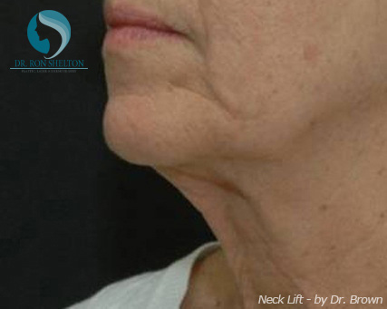 <?php echo $pk; ?> - Before Case 1