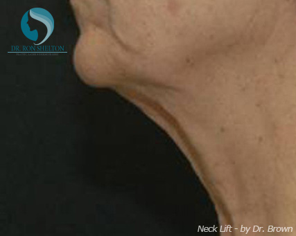 <?php echo $pk; ?> - Before Case 2