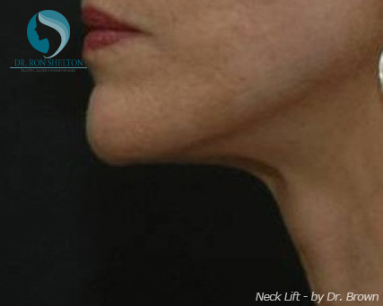 <?php echo $pk; ?> - After Case 3