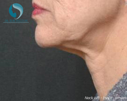 <?php echo $pk; ?> - Before Case 3