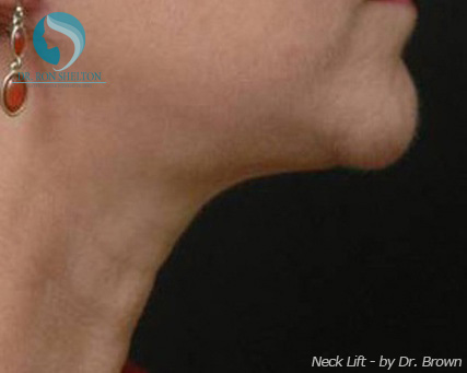 <?php echo $pk; ?> - After Case 5