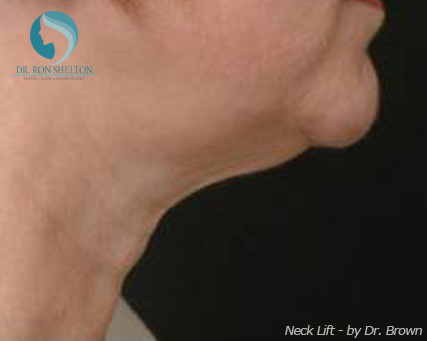 <?php echo $pk; ?> - Before Case 5