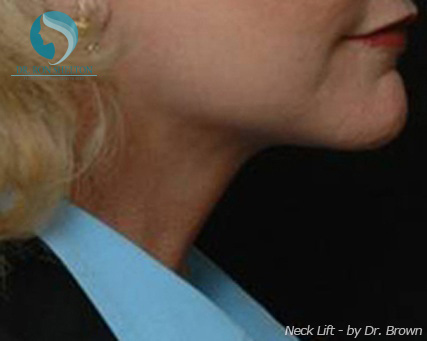 <?php echo $pk; ?> - After Case 4