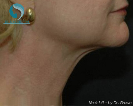 <?php echo $pk; ?> - Before Case 4