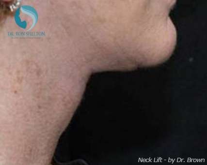 <?php echo $pk; ?> - After Case 6