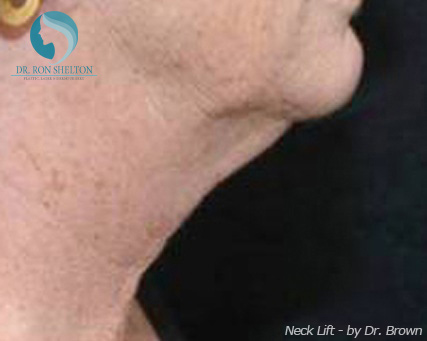 <?php echo $pk; ?> - Before Case 6