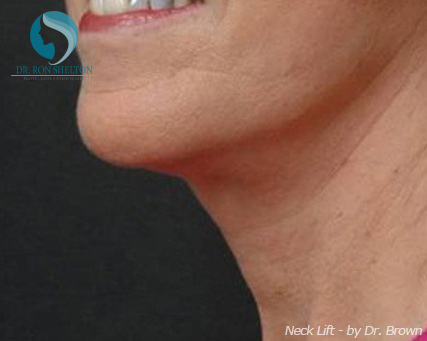 <?php echo $pk; ?> - After Case 1