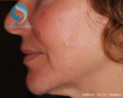 <?php echo $pk; ?> - After Case 3