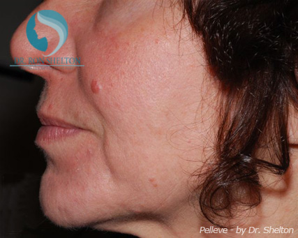 <?php echo $pk; ?> - Before Case 3