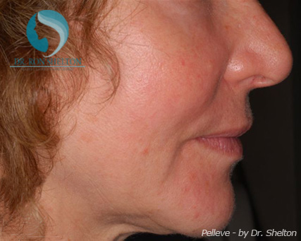 <?php echo $pk; ?> - After Case 2