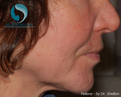 <?php echo $pk; ?> - Before Case 2