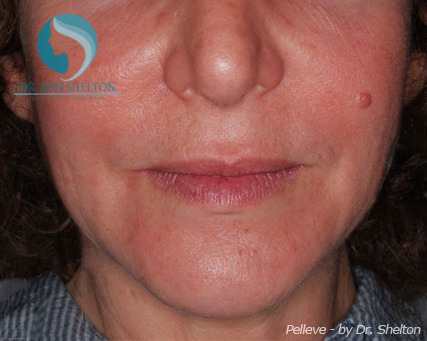 <?php echo $pk; ?> - After Case 1