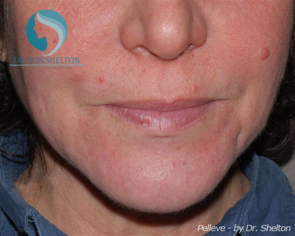 <?php echo $pk; ?> - Before Case 1