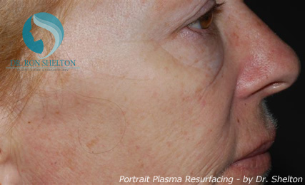 <?php echo $pk; ?> - After Case 1