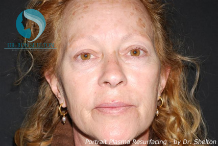 <?php echo $pk; ?> - Before Case 2