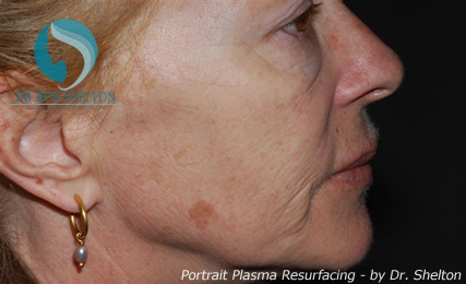 <?php echo $pk; ?> - Before Case 1