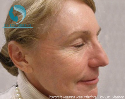 <?php echo $pk; ?> - Before Case 4