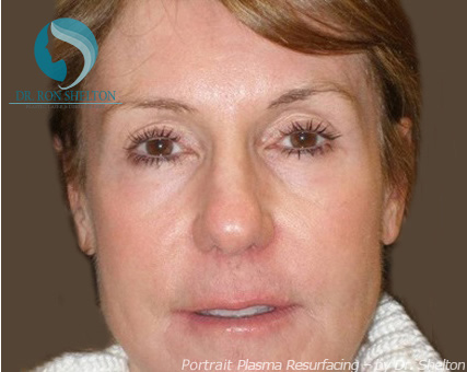 <?php echo $pk; ?> - After Case 5