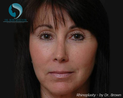 Rhinoplasty New York City - After Case 4