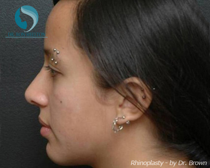 Rhinoplasty New York City - After Case 2