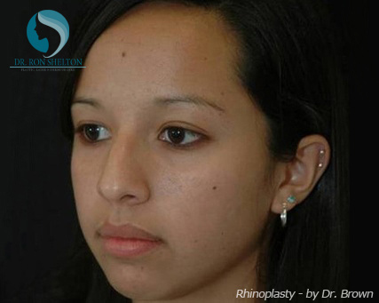 Rhinoplasty New York City - Before Case 1