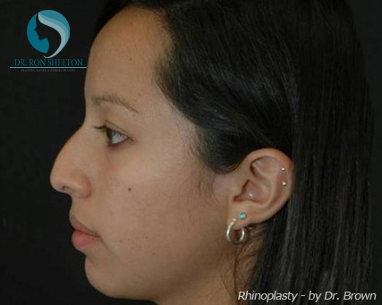 Rhinoplasty New York City - Before Case 2