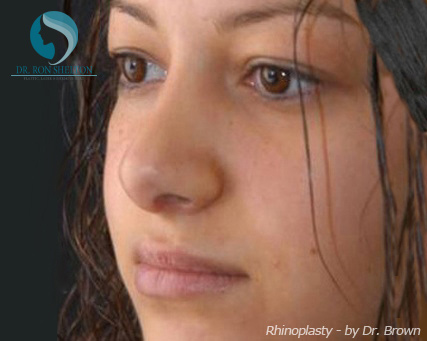 Rhinoplasty New York City - After Case 8