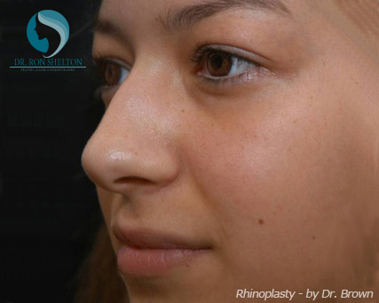 Rhinoplasty New York City - Before Case 8