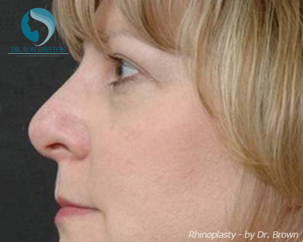 Rhinoplasty New York City - After Case 7