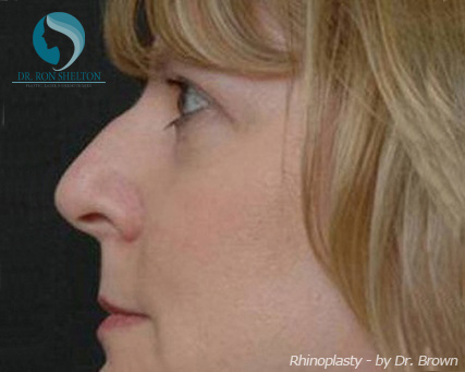 Rhinoplasty New York City - Before Case 7
