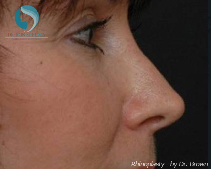 Rhinoplasty New York City - After Case 5