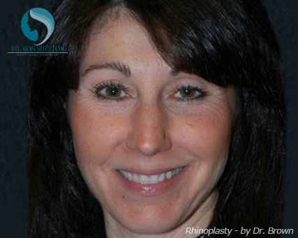 Rhinoplasty New York City - Before Case 4