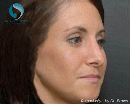Rhinoplasty New York City - After Case 3